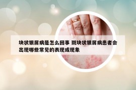 块状银屑病是怎么回事 斑块状银屑病患者会出现哪些常见的表现或现象