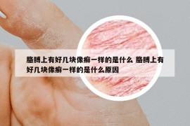 胳膊上有好几块像癣一样的是什么 胳膊上有好几块像癣一样的是什么原因