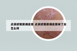 点滴状银屑病皮屑 点滴状银屑病皮屑掉了会怎么样