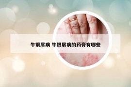 牛银屑病 牛银屑病的药膏有哪些
