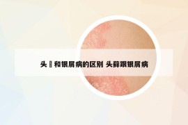 头廯和银屑病的区别 头藓跟银屑病