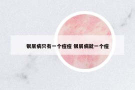 银屑病只有一个痘痘 银屑病就一个痘