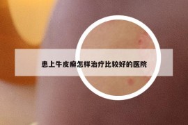 患上牛皮癣怎样治疗比较好的医院