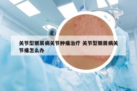关节型银屑病关节肿痛治疗 关节型银屑病关节痛怎么办