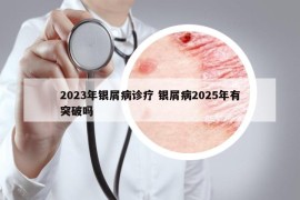 2023年银屑病诊疗 银屑病2025年有突破吗