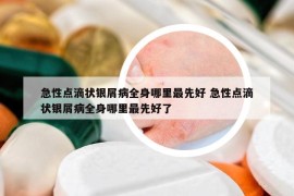 急性点滴状银屑病全身哪里最先好 急性点滴状银屑病全身哪里最先好了