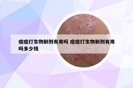 痘痘打生物制剂有用吗 痘痘打生物制剂有用吗多少钱