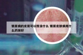 银屑病的皮屑可以擦涂什么 银屑皮肤病用什么药抹好