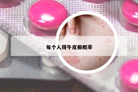 每个人得牛皮癣概率