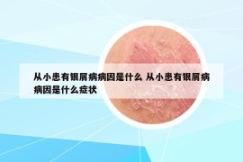 从小患有银屑病病因是什么 从小患有银屑病病因是什么症状