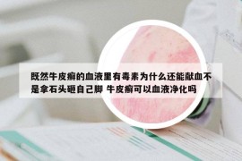 既然牛皮癣的血液里有毒素为什么还能献血不是拿石头砸自己脚 牛皮癣可以血液净化吗