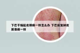 下巴干燥起皮跟癣一样怎么办 下巴反复掉皮屑像癣一样
