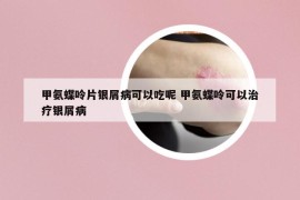 甲氨蝶呤片银屑病可以吃呢 甲氨蝶呤可以治疗银屑病