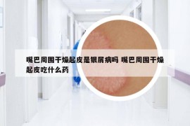 嘴巴周围干燥起皮是银屑病吗 嘴巴周围干燥起皮吃什么药