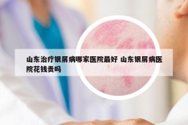山东治疗银屑病哪家医院最好 山东银屑病医院花钱贵吗