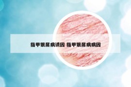 指甲银屑病诱因 指甲银屑病病因