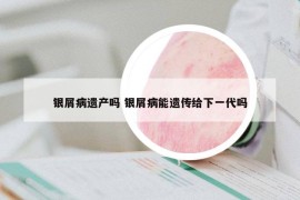 银屑病遗产吗 银屑病能遗传给下一代吗