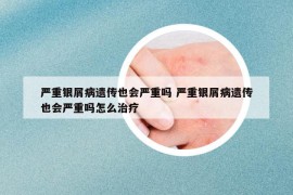 严重银屑病遗传也会严重吗 严重银屑病遗传也会严重吗怎么治疗