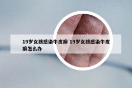 19岁女孩感染牛皮癣 19岁女孩感染牛皮癣怎么办