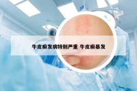 牛皮癣发病特别严重 牛皮癣暴发