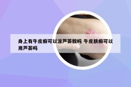 身上有牛皮癣可以涂芦荟胶吗 牛皮肤癣可以用芦荟吗