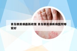 青岛银屑病最新政策 青岛银屑病疾病医院哪家好