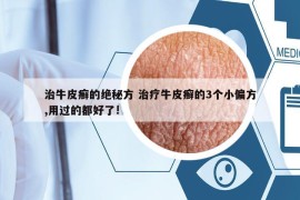 治牛皮癣的绝秘方 治疗牛皮癣的3个小偏方,用过的都好了!