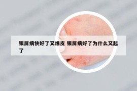 银屑病快好了又爆皮 银屑病好了为什么又起了