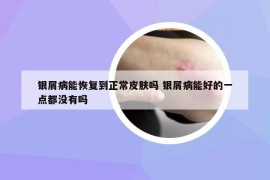 银屑病能恢复到正常皮肤吗 银屑病能好的一点都没有吗