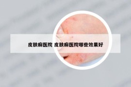 皮肤癣医院 皮肤癣医院哪些效果好