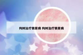 构树冶疗银屑病 构树治疗银屑病