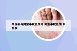 牛皮癣与同型半胱氨酸高 同型半胱氨酸 银屑病
