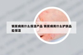 银屑病用什么保湿产品 银屑病用什么护肤品能保湿