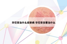 华佗膏治什么皮肤病 华佗膏主要治什么