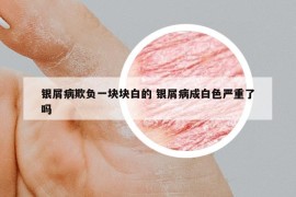 银屑病欺负一块块白的 银屑病成白色严重了吗