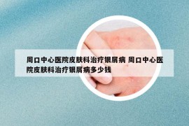 周口中心医院皮肤科治疗银屑病 周口中心医院皮肤科治疗银屑病多少钱