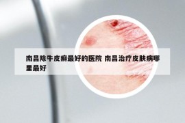 南昌除牛皮癣最好的医院 南昌治疗皮肤病哪里最好