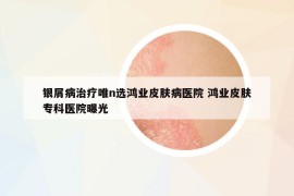 银屑病治疗唯n选鸿业皮肤病医院 鸿业皮肤专科医院曝光