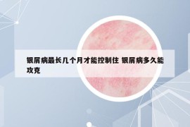 银屑病最长几个月才能控制住 银屑病多久能攻克