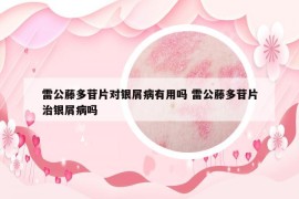 雷公藤多苷片对银屑病有用吗 雷公藤多苷片治银屑病吗