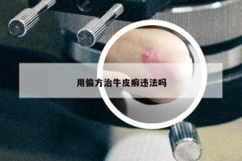 用偏方治牛皮癣违法吗