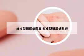 红皮型银屑病医案 红皮型银屑病贴吧