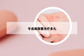 牛皮癣需要光疗多久