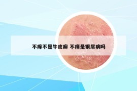 不痒不是牛皮癣 不痒是银屑病吗