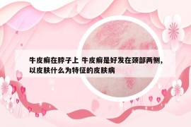 牛皮癣在脖子上 牛皮癣是好发在颈部两侧,以皮肤什么为特征的皮肤病