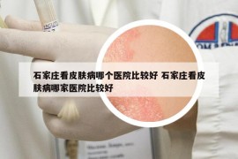 石家庄看皮肤病哪个医院比较好 石家庄看皮肤病哪家医院比较好
