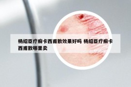 杨绍臣疗癣卡西甫散效果好吗 杨绍臣疗癣卡西甫散哪里卖