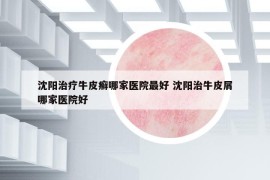 沈阳治疗牛皮癣哪家医院最好 沈阳治牛皮屑哪家医院好