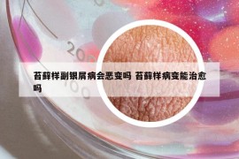 苔藓样副银屑病会恶变吗 苔藓样病变能治愈吗