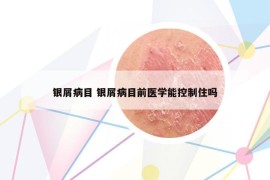 银屑病目 银屑病目前医学能控制住吗